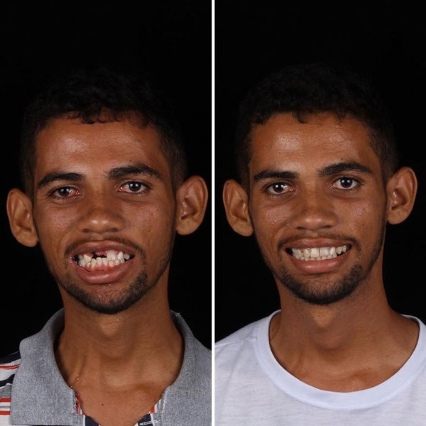 一張圖看出牙齒多重要！巴西牙醫到世界各地幫助窮人補牙，直接改變一個人的面相！