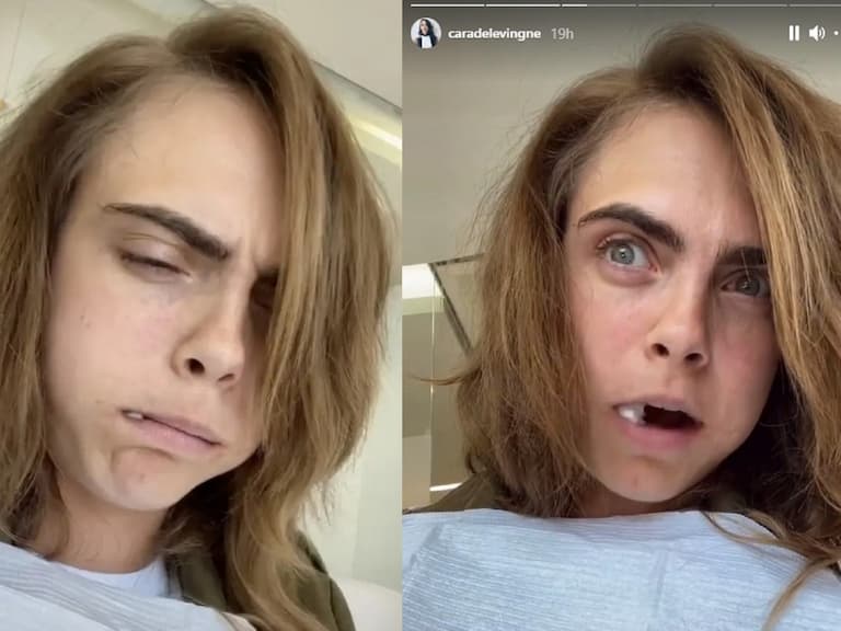 英國超模也懂!Cara Delevingne 拔智齒痛到懷疑人生:「我一直爆哭!」