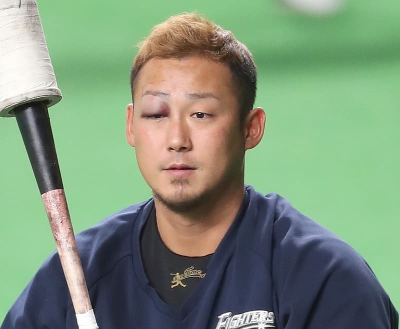 火腿隊明星內野手中田翔，在休息室跌倒撞到右眼瘀青