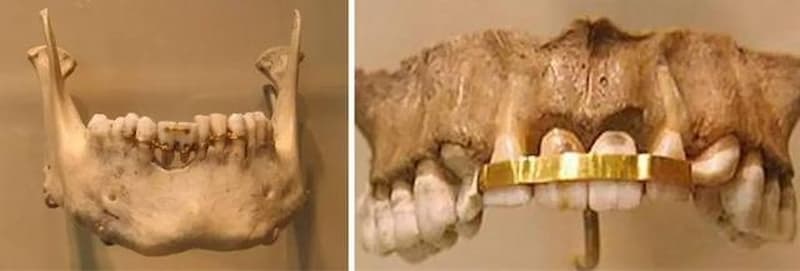 在牙齒上鑲入昂貴金屬的起源，最早可追溯至古埃及和瑪雅人的古文明。