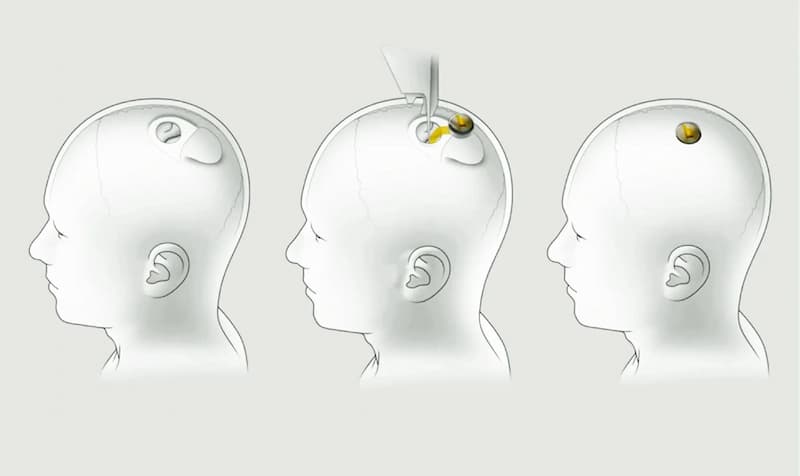 馬斯克打造的大腦晶片公司 Neuralink 從腦中有線設備，到目前已經無線，適合用在人類身上，目標除了讓半身癱瘓的患者能透過腦波使用電腦、手機，還希望每個人都有機會透過晶片，處理智慧手機上的事物