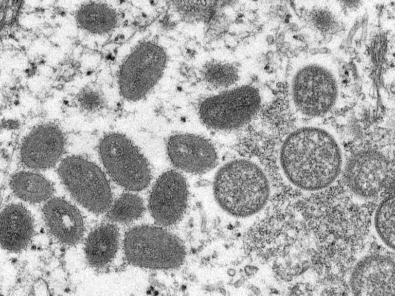 義大利男出國 5 天後卻同時感染「新冠、愛滋加猴痘病毒」，成為全球首例！