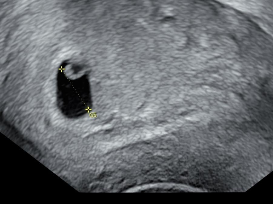 鄭家純懷孕不幸流產!深夜痛到大叫:「胚胎停止發育!」