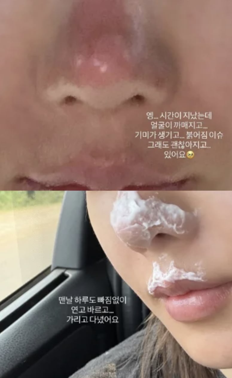 權恩妃挑戰非洲最高峰臉部二度灼傷！多張鼻頭脫皮紅腫曝光！