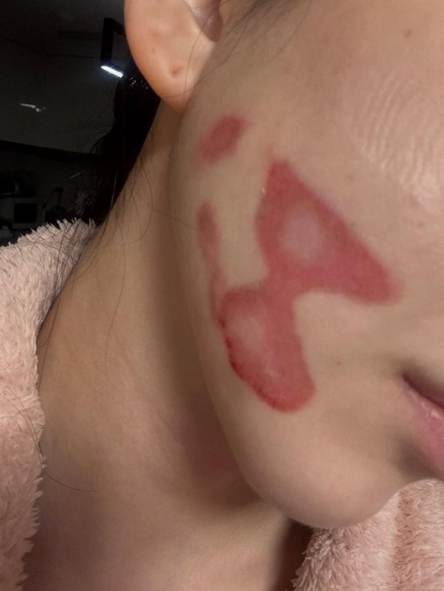 AOA 珉娥臉部醫美二級燙傷！痛述：「像皮膚被撕裂般！」