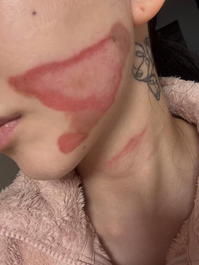 AOA 珉娥臉部醫美二級燙傷！痛述：「像皮膚被撕裂般！」