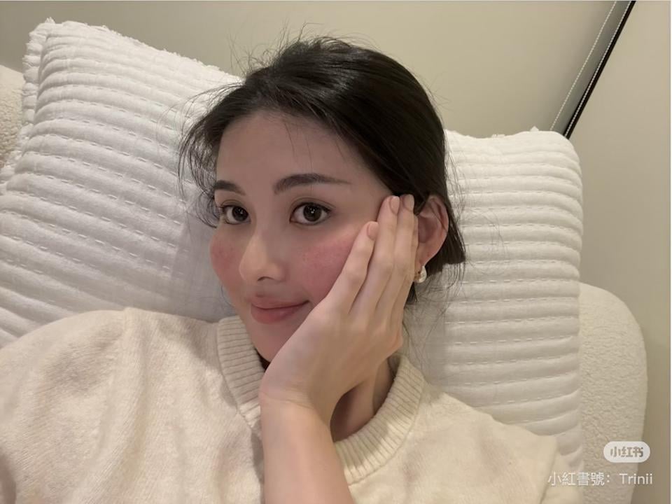 孫芸芸女兒廖思惟曝素顏照!玫瑰斑發作坦言:「我不完美!」