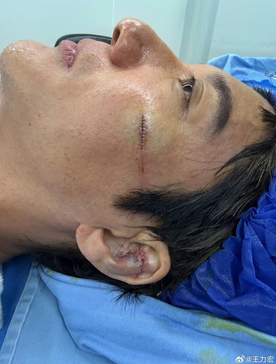 王力宏演唱會重摔濺血!左臉撞舞台階梯,自嘲:「我有點像梵谷!」