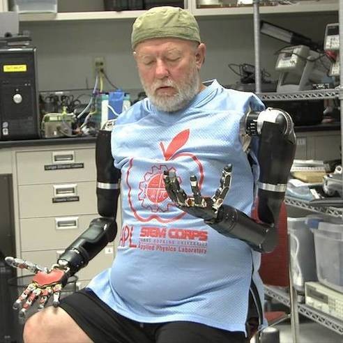 這名失去 40 年雙臂的男子  獲准取得全球第一對可以用「腦」控制的機器雙手