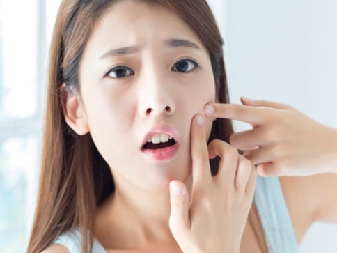 為什麼一直長痘痘？ 4 張「痘痘生長位置表」揭開真正長痘原因！