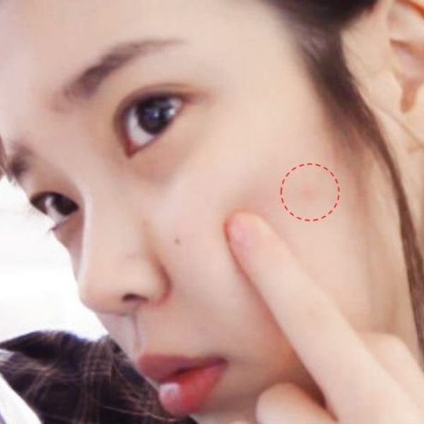 炎夏痘痘冒不停 底妝再厚都遮不了？超簡單 2 招「遮痘訣竅」 輕鬆打造無瑕妝容～