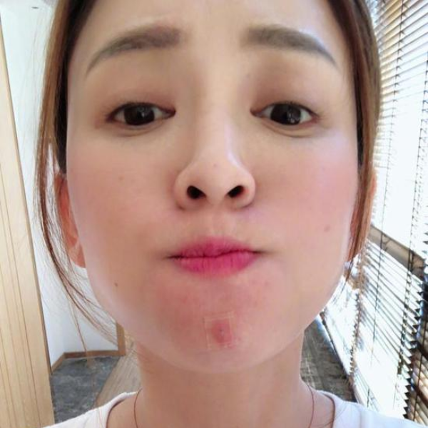 連蔡依林、陳喬恩都因為痘痘毀顏值！女人每月必經的「姨媽痘」靠「這個訣竅」痘印不留白～