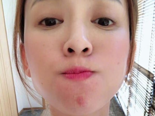 連蔡依林、陳喬恩都因為痘痘毀顏值!女人每月必經的「姨媽痘」靠「這個訣竅」痘印不留白~